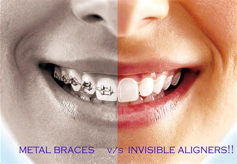 metal braces vs clear aligners